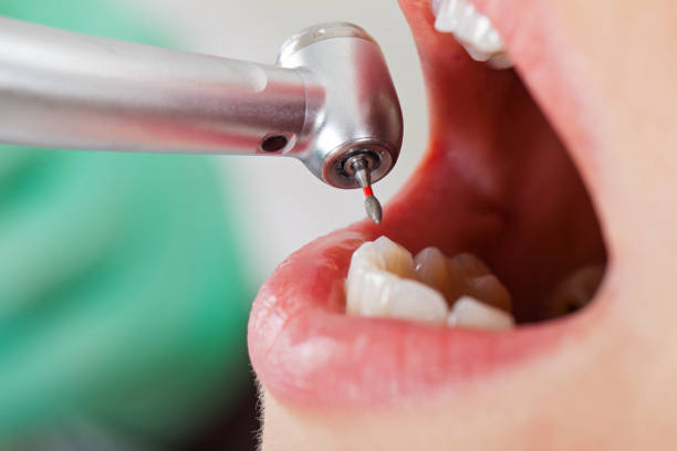 Best Dentist for Tooth Abscess  in Clarkston, GA